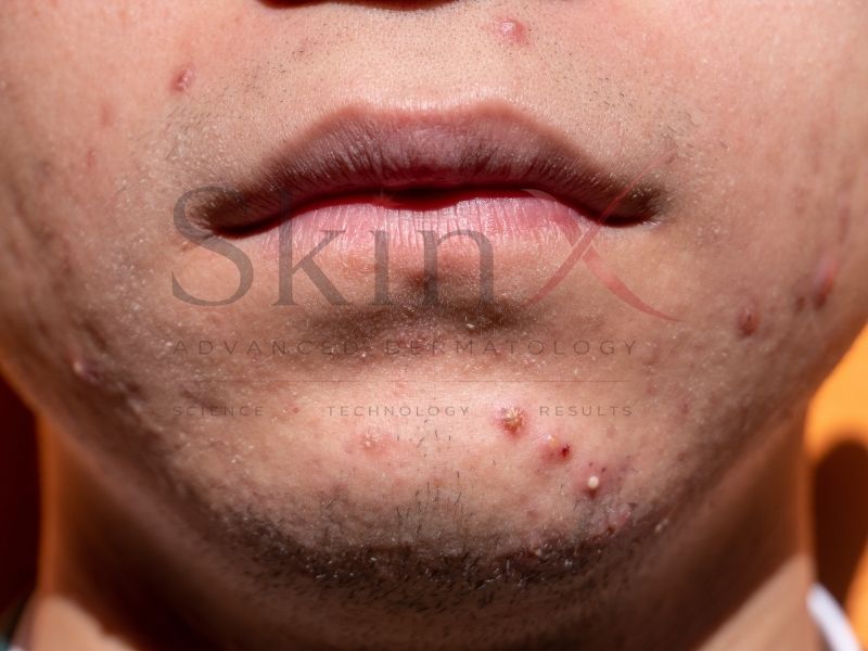 Mụn sưng viêm kéo dài, gây cảm giác đau nhức khó chịu.